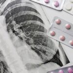 Fund cuts disrupt TB services worldwide