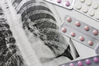Fund cuts disrupt TB services worldwide