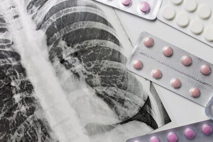 Fund cuts disrupt TB services worldwide
