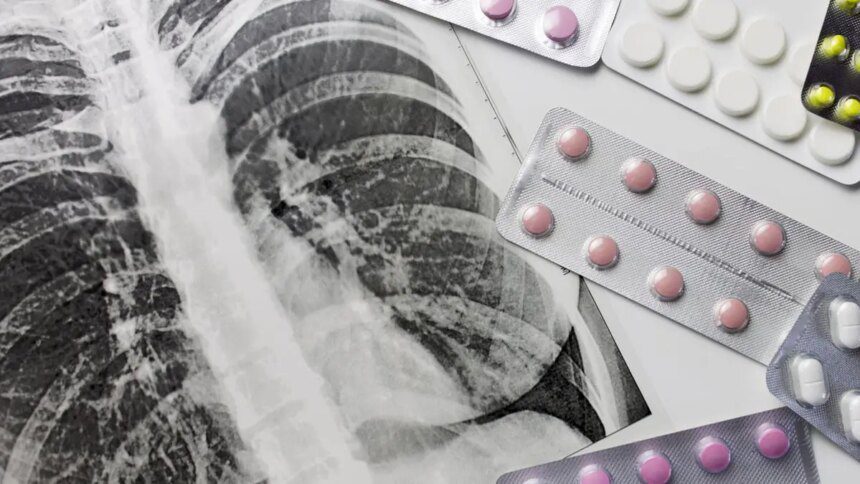 Fund cuts disrupt TB services worldwide
